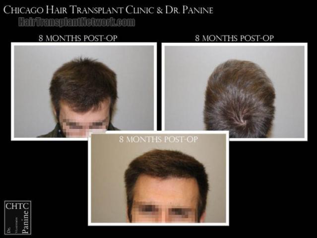 Hair restoration procedure before and after results