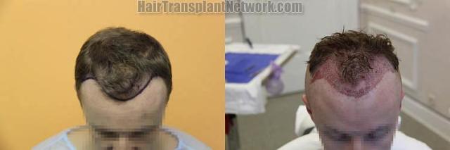 Hair restoration procedure before and after results