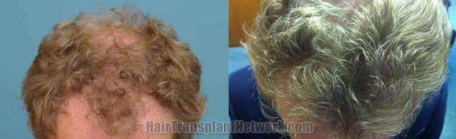 Before and after hair transplant procedure images