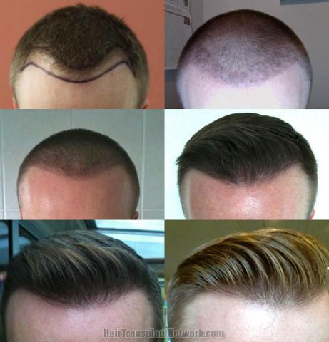 Hair transplantation surgery before and after photos