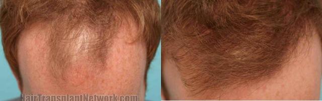 Hair restoration procedure before and after results