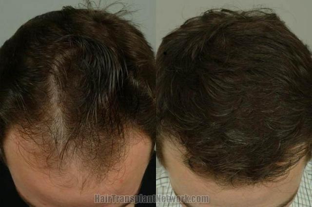 Hair restoration procedure before and after pictures