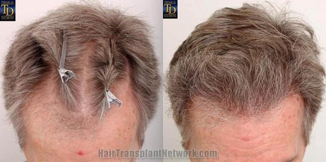 Hair restoration procedure before and after results