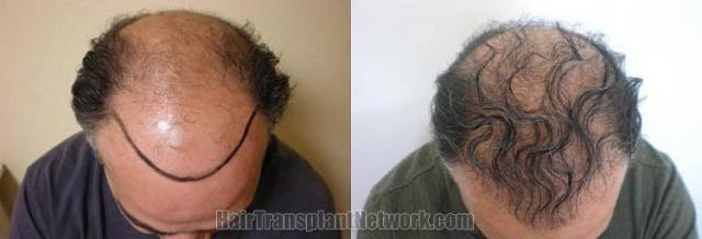 Top view before and after hair restoration results