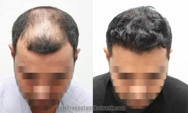 Before and after hair transplant procedure images