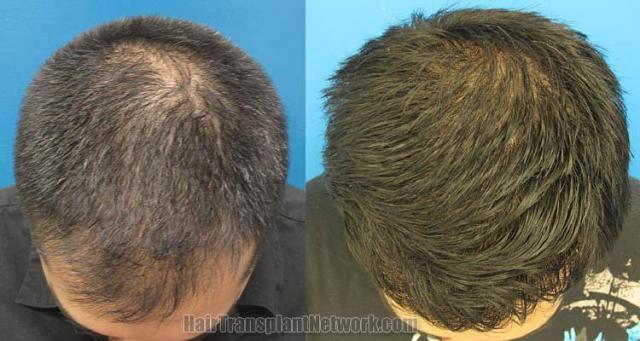 Top view before and after hair restoration results