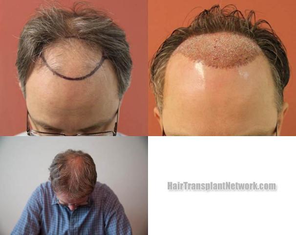 Hair restoration procedure before and after results