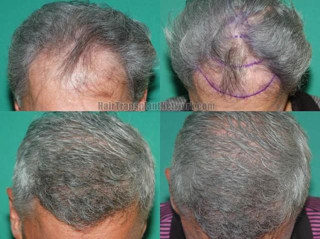 Top view before and after hair restoration results