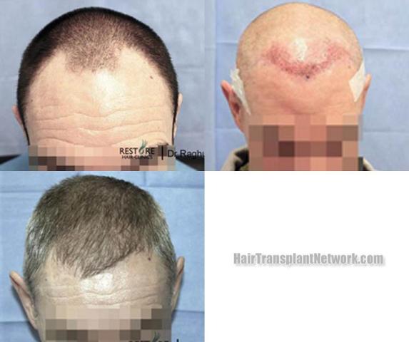 Hair transplantation surgery before and after photos