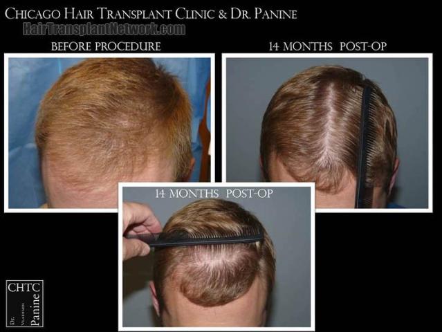 Hair transplantation surgery before and after photos