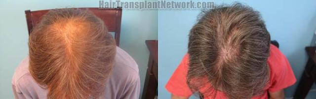 Surgical hair transplantation result photographs