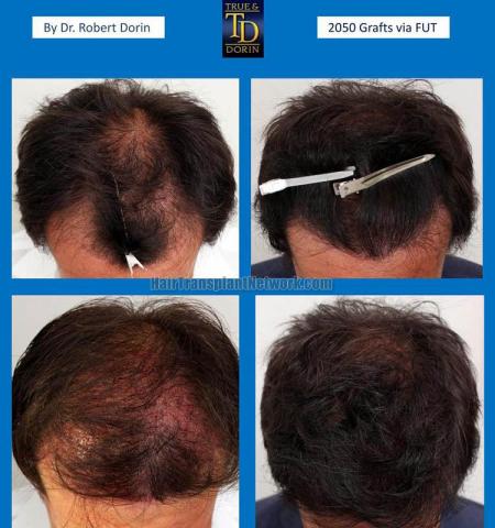 Hair transplantation surgery before and after photos