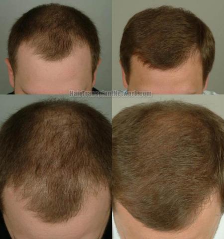 Top view before and after hair restoration results