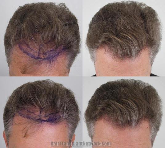 Hair transplantation surgery before and after photos