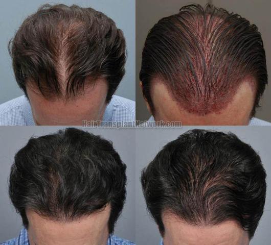 Hair restoration procedure before and after results