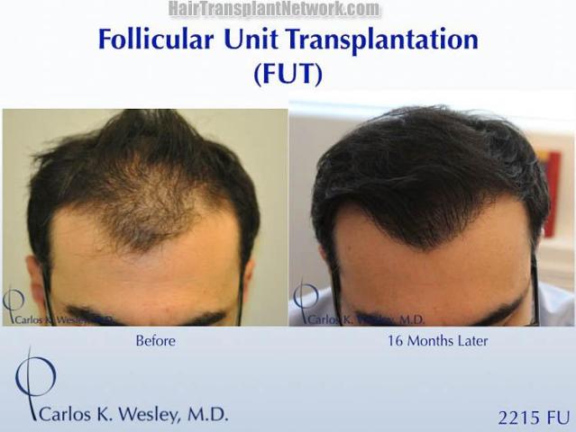 Before and after hair transplantation result photographs