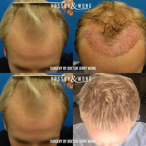 Before and after hair restoration procedure images