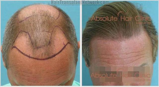 Hair restoration procedure before and after results