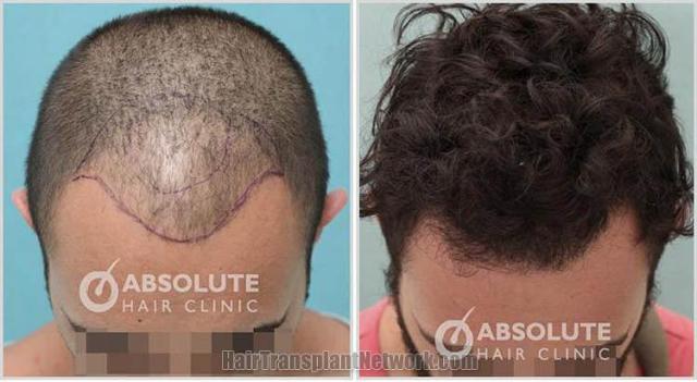 Hair restoration procedure before and after result photos