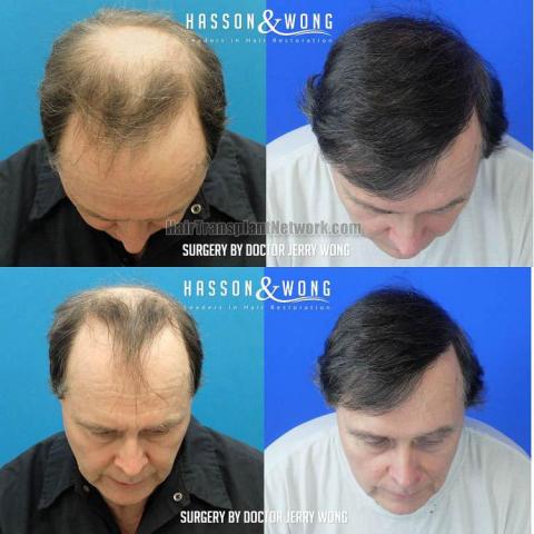 Hair transplantation surgery before and after images