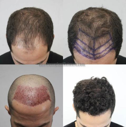 Hair restoration procedure before and after results