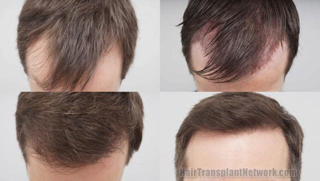 Hair restoration procedure before and after results