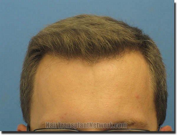 Hair restoration procedure results