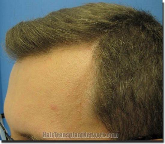 Hair restoration procedure results