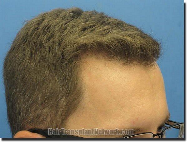 Hair restoration procedure results