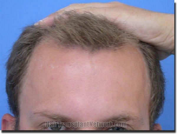 Hair restoration procedure results