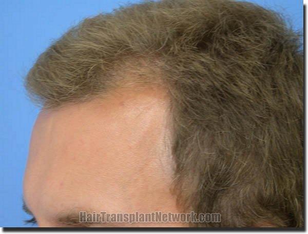 Hair restoration procedure results