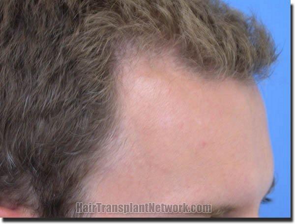 Hair restoration procedure results