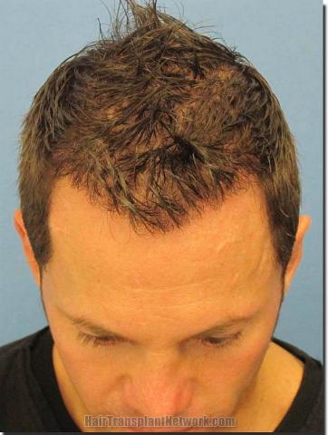 Hair restoration procedure results