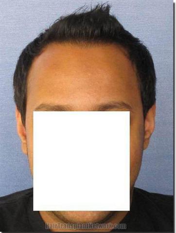 Hair restoration procedure results