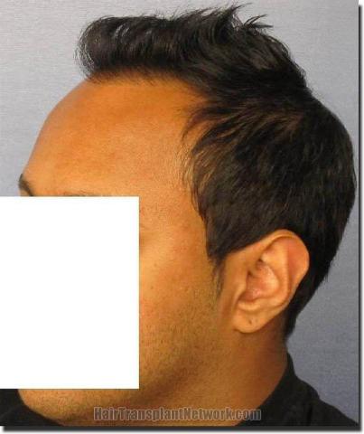 Hair restoration procedure results