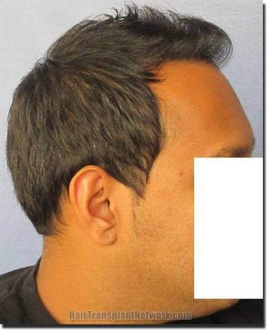 Hair restoration procedure results