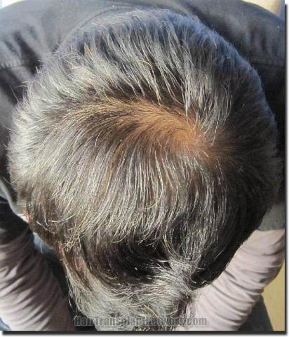 Hair restoration procedure results