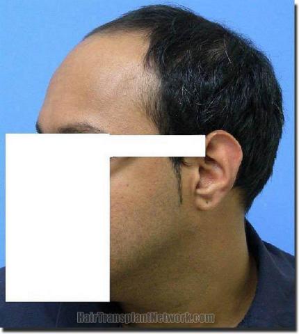 Hair restoration procedure results