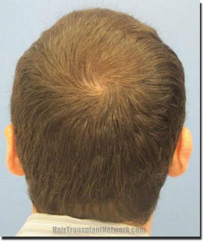 Hair restoration procedure results