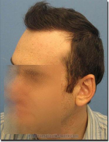 Hair restoration procedure results