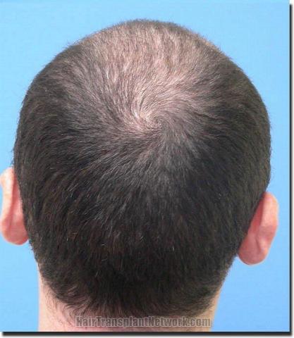 Hair restoration procedure results