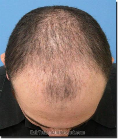 Hair restoration procedure results