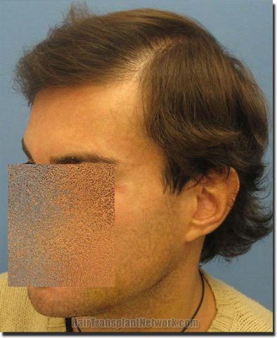 Hair restoration procedure results