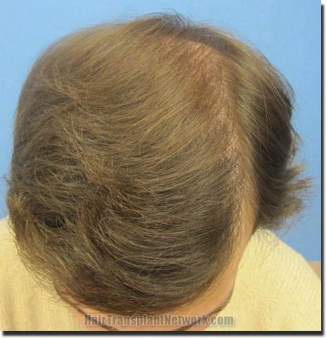 Hair restoration procedure results