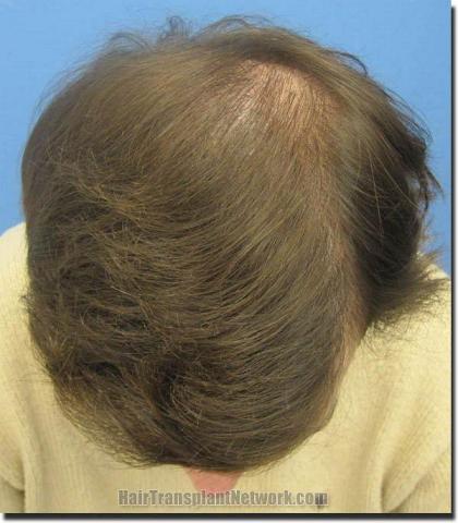 Hair restoration procedure results