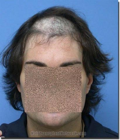 Hair restoration procedure results