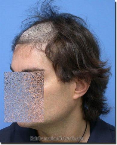 Hair restoration procedure results