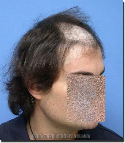 Hair restoration procedure results