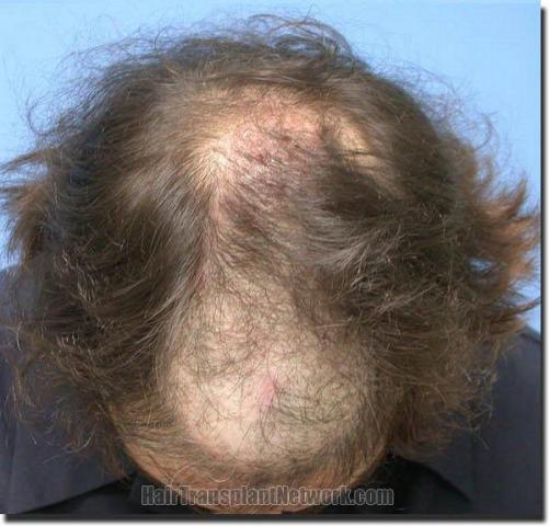 Hair restoration procedure results