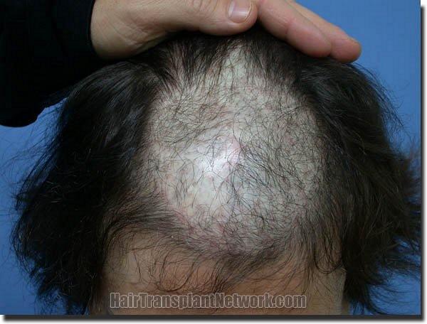 Hair restoration procedure results